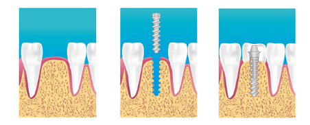 Dents artificielles et prothèses implantaires en 24-48 heures - Heraeus